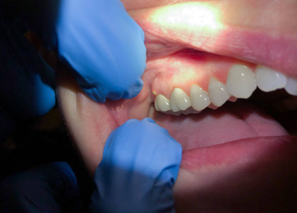 Best Emergency Tooth Extraction in Lebanon, NH